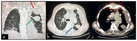 A rare incidence of malignant pleural effusion in multiple myeloma ...