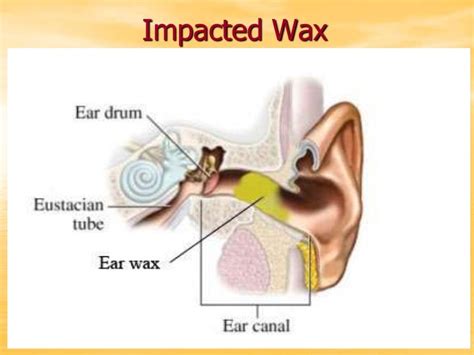 Impacted wax