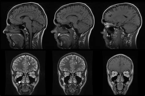 Neuroglial cyst or large PVS, MRI (2 of 2) | MRI shows a clu… | Flickr