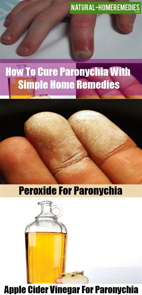 Acne Home Remedies For Dry Skin: Paronychia Toe Home Remedies