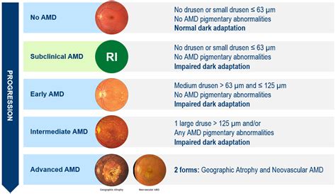 Age-Related Macular Degeneration & Its Stages · AMD Biology