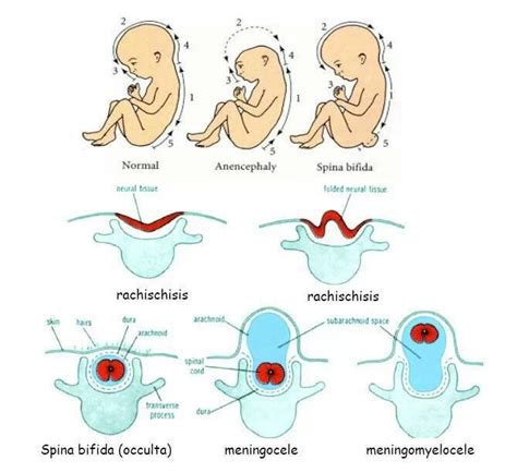 Neural tube defect | Pediatric nursing, Nursing school prerequisites, Pediatric physical therapy