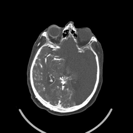 Unintended intra-arterial injection of contrast | Radiology Case ...