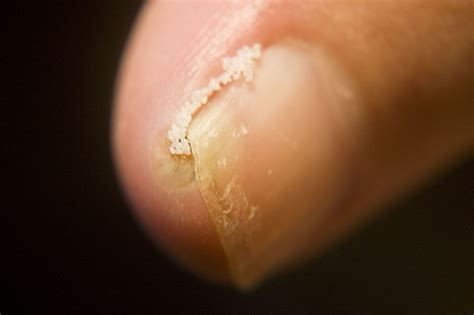 Flea located under toenail - Tunga penetrans | Flickr - Photo Sharing!