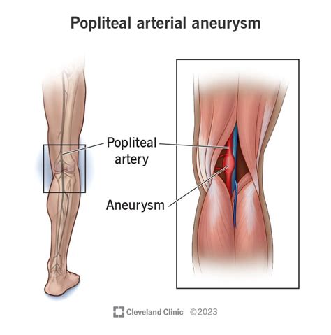 Popliteal Aneurysm: Symptoms & Treatment