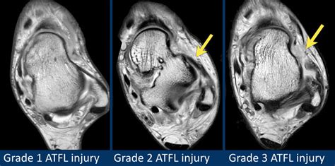 The Radiology Assistant : Ankle - MRI examination