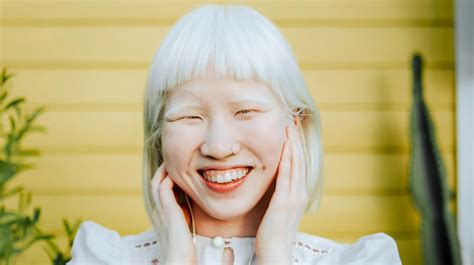 How To Prevent Albinism - Understandingbench16