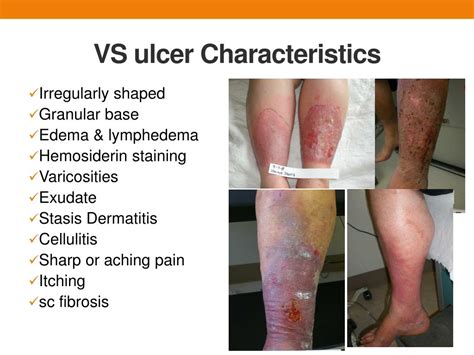 PPT - Venous Stasis Management and Ulcer Healing PowerPoint ...