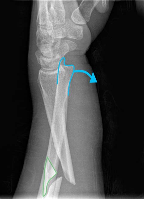 Galeazzi fracture-dislocations