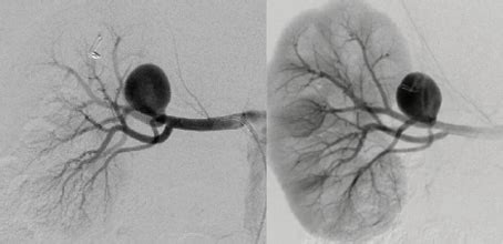 Endovascular Today - Growing Right Renal Artery Aneurysm (August 2017)