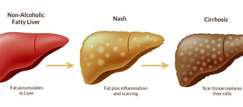 What is NASH related Cirrhosis