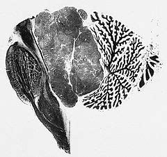 Ependymoma - Libre Pathology