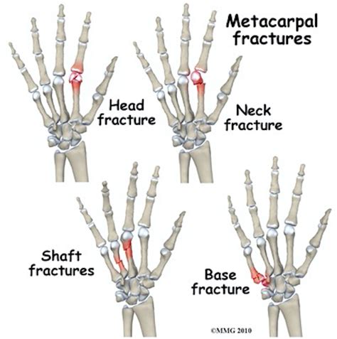 Metacarpal fracture symptoms - fundnery