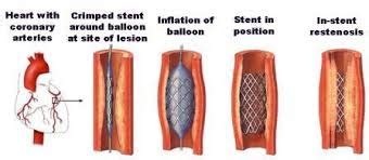 Chinese Medicine Forum: How to prevent and treat coronary in-stent restenosis with Chinese medicine?