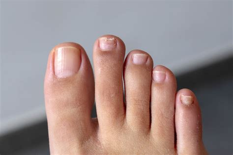 Nail Fungus - Causes, Symptoms And Treatment - 2024 Guide - Demotix.com