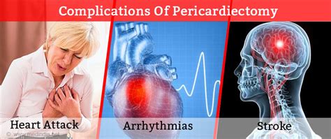 Pericardiectomy - Indications, Preparation, Procedure, Recovery & Complications