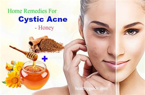 18 Best Home Remedies for Cystic Acne On Face, Neck, Nose, Cheek, Forehead