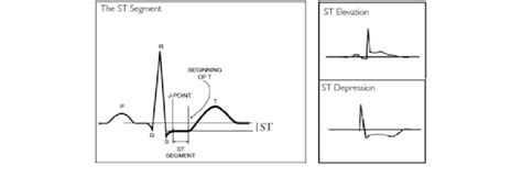 ST segment measurement [4] | Download Scientific Diagram