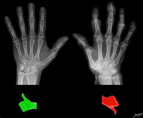 Osteoarthritis | Hands