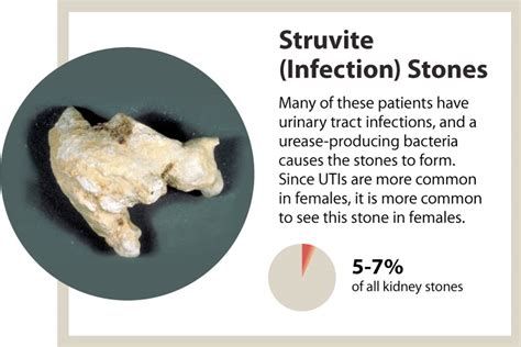 UAB - News - Kidney stones - a marker of overall kidney health