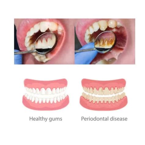 Periodontal Disease: Causes, Symptoms And Home Treatment.