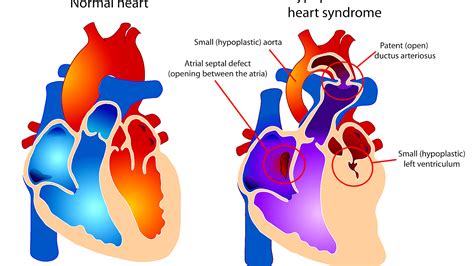 Hypoplastic Left Heart Syndrome Symptoms - Hear Choices