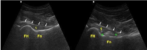 Ultrasound guided injection of hip joint (longitudinal scan). Before ...