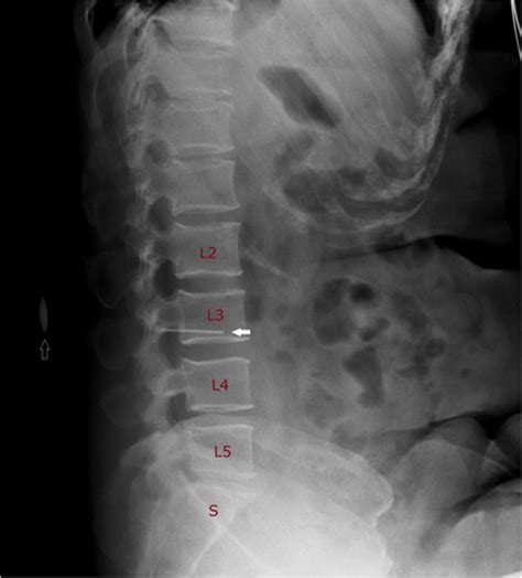 Lumbar Spine Xray