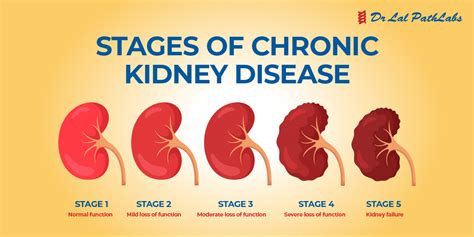 Kidney Disease: Types, Symptoms & Diagnosis - Dr Lal PathLabs Blog