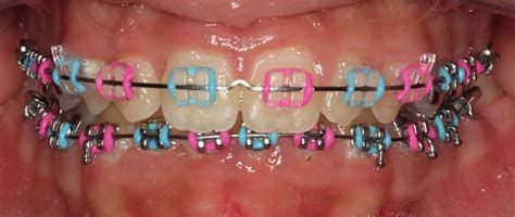 Braces Colours - Show off your personality with colour!