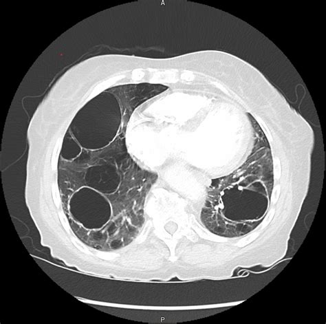 Cureus | An Unusual Case of Severe Cystic Lung Disease: A Case Report ...