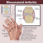 Understanding Rheumatoid Arthritis: Prevention, Treatment, and Trends - Becker Spine
