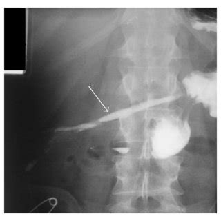 (PDF) Endoscopic Treatment of a Gastrocutaneous Fistula Using the Over-The-Scope-Clip System: A ...