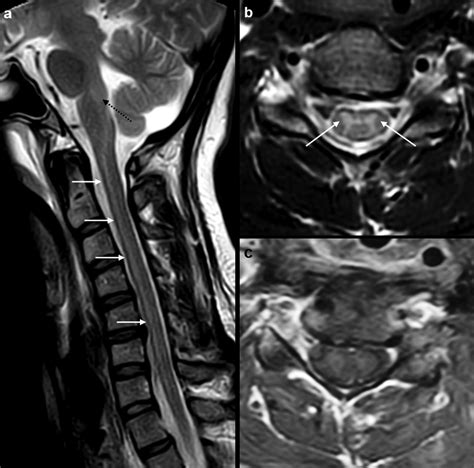 -MRI cervical spine study at time of admission in ICU of our institute.... | Download Scientific ...