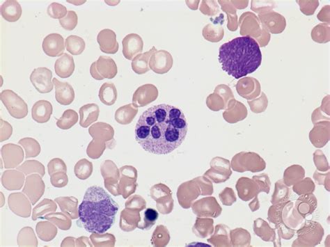 Hypersegmented neutrophil - 2.