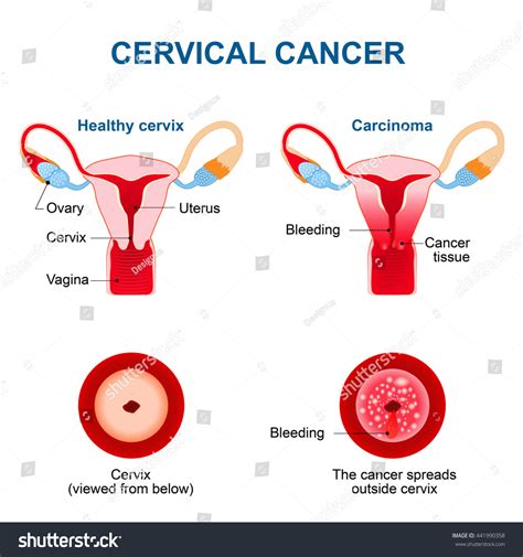 Cervical Cancer. Malignant Neoplasm Arising From Cells In The Cervix Uteri. Vaginal Bleeding ...