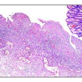 This image shows mucosal ulcer area (a) with the cells containing viral ...