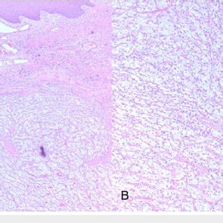 Histological micrograph showing skin with underlying renal cell... | Download Scientific Diagram