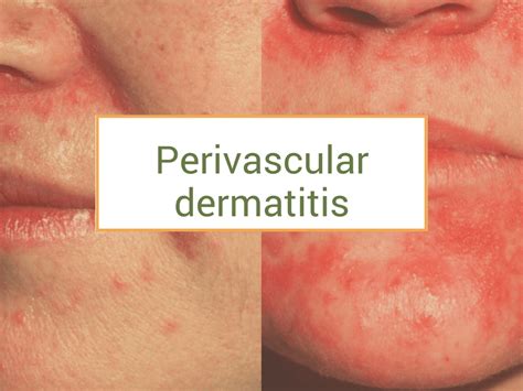 Perivascular dermatitis: treatments and natural recipes (with pictures)