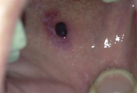 Blood blister in mouth: Causes and remedies