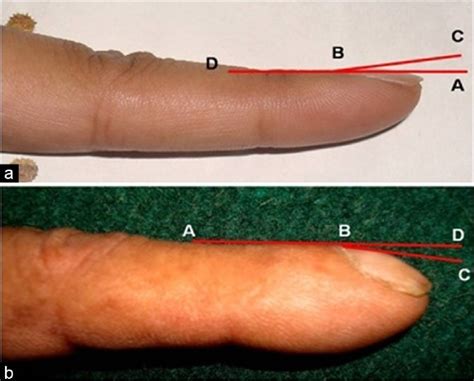 Digital Clubbing or Nail Clubbing - Causes and Grading | medcaretips.com