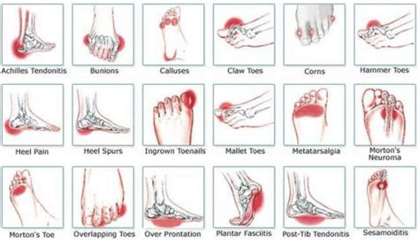 Foot pain - All you need to know (2022)