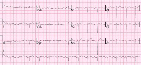 Dr. Smith's ECG Blog: Tachycardia with Pericardial Effusion