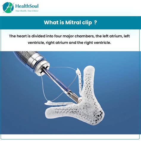 Mitral Clip: Indications and Complications – Healthsoul