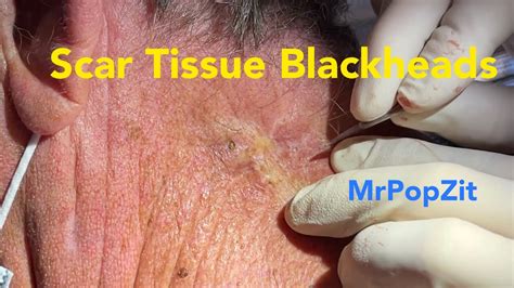 Embedded scar tissue blackhead extractions. Deep squeeze. MrPopZit - YouTube