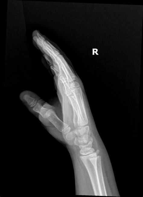 OrthoDx: Thumb Dislocation in Child - Clinical Advisor