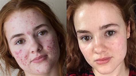 This Woman's Accutane Transformation Photos Went Viral — Before and ...