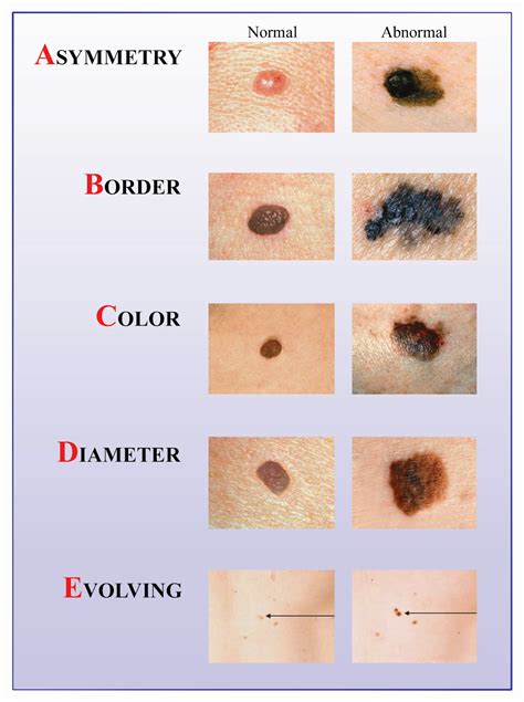 Remember the ABCDEs of Melanoma! | The Eye Associates