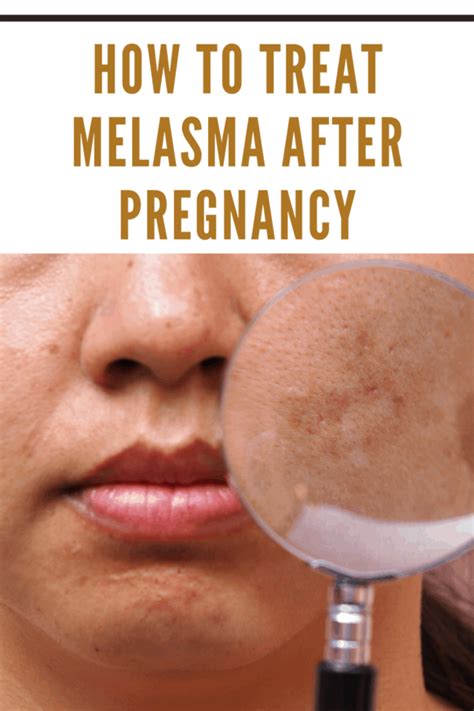 3 Methods to Treat Melasma After Pregnancy • Mommy's Memorandum