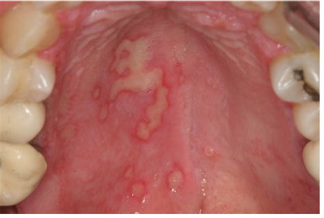 Benign Infectious Lesions/Conditions of the Oral Mucous Membrane | IntechOpen